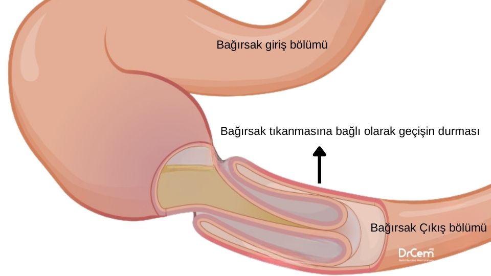 İntestinal Obstrüksiyon görseli - DrCem hastalık rehberi
